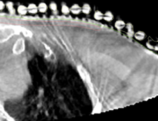 Brachytherapy CBCT Image