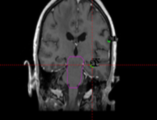 Gamma Knife CBCT Image