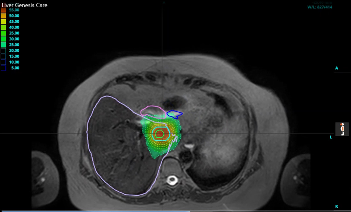 MR-Guided radiation therapy for liver cancer | Products | Elekta