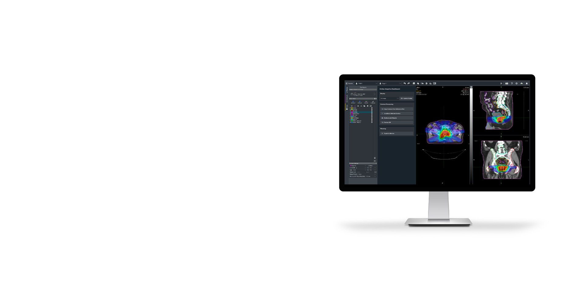 Radiation Therapy Treatment Planning | Elekta