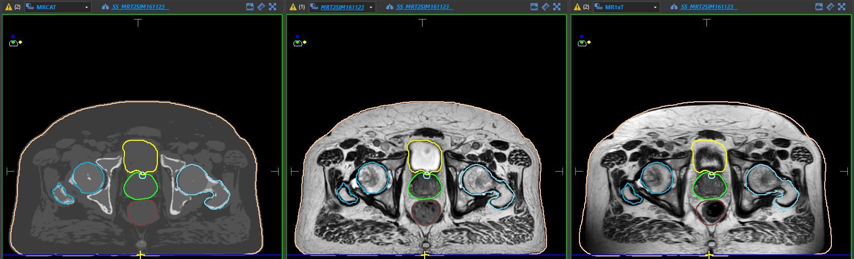 Mrcat Rmsim 1 Daytreatment