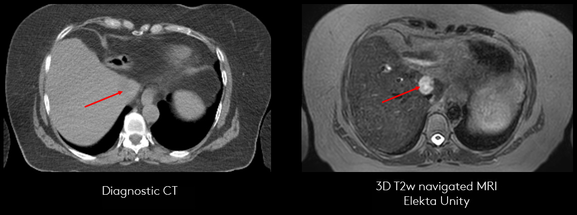 Exquisite visualization of liver tumours with Elekta Unity MR-Linac