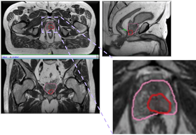 Escalate Dose to Tumor