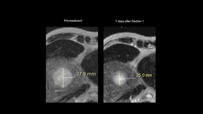 Liver tumor shrinkage visualized on Elekta Unity MR-Linac